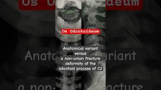 Fractured Neck?🚑 Os Odontoideum #neckpain #bones #radiology