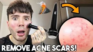 HOW TO GET RID OF ACNE SCARS AND DARK SPOTS || (MICRONEEDLING TUTORIAL WITH BANISH)
