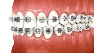 Orthodontic Bracket positioning: typodont exercise for beginners by Dr Vandana Katyal, Orthodontist
