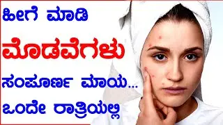 Pimple Ge Mane Maddu Kannada | Pimple Kale Tips In Kannada #shorts