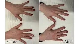 Hand rejuvenation at Anti Aging Vancouver