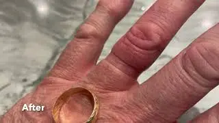 Before & After 2 - Ring Rescue Compression Device Kit