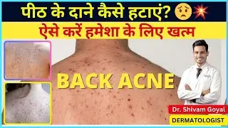 Back Acne का इलाज | पीठ के मुंहासे कैसे हटाएं | Causes & Treatment in Hindi
