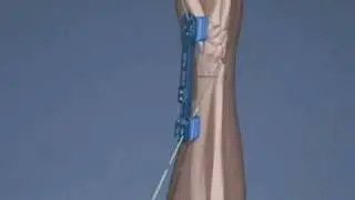 Cross Pin Fixation System