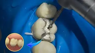 OLD DENTAL FILING REPLACED by a Natural White Restoration