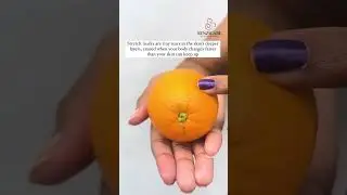 Stretch marks on your breasts?