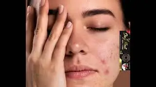 Day First Acne Cream