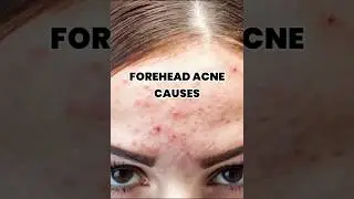 Forehead Acne Causes | skin care tips #shorts