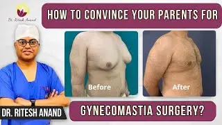 Opening Up About Gynecomastia Surgery: A Guide to Talking with Your Parents | Dr Ritesh Anand
