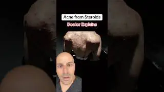 Doctor Explains Acne from Steroids