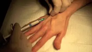 Radiesse Hand Rejuvenation - Dr. Nissan Pilest (Irvine, CA)
