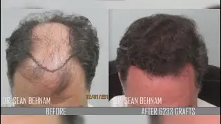 Amazing 7,100-graft journey of a gentleman from bald to bold.