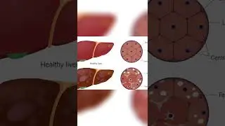 Demystifying Fibroscan: A Window into Your Liver's Health
