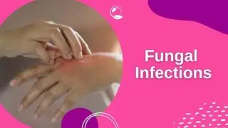 Fungal Infection Care1.Have less salt intake.