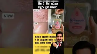 ලස්සන වෙන්න කුරුලෑ කැලැල් නැති කරන ගන්න ❤️ sudu wenna krama #skincare
