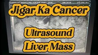 Liver Mass | Jigar ka Cancer | Hepatocellular Carcinoma | Ultrasound Liver #liver  #mass 