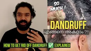എങ്ങനെ താരൻ Dandruff അകറ്റാം?!! Things to Know, Facts, Natural Remedies, How to Maintain explained✅