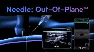 iQ3: Needle: Out-of-Plane | Butterfly Network