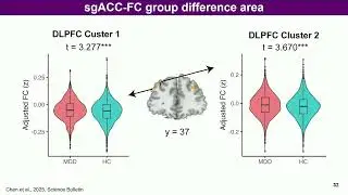 OHBM 2025 | Symposium | Chao-gan Yan | Leveraging DIRECT fMRI Large-scale Data for Precision TMS T&hellip;