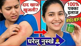 Daad, Khujli, Fungal Infection को जड़ से खत्म करें | Best Fungal #infection #treatment in Hindi