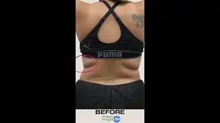 😱Strawberry Laser Treatment Before/After #youtubeshorts #shorts