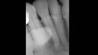 Hypercementosis and apical periodontitis