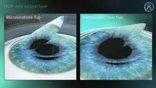LASIK AHPL ver 1 1
