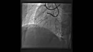 Multi-vessel diffuse disease. HDR cto intervention of RCA and DCB to LAD 