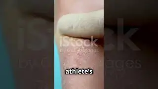 Tinea Cruris (Jock Itch) &ndash; A Common Men&rsquo;s Skin Problem
