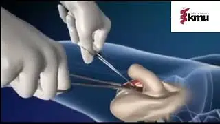 Penis To Vagina Transplant 3D Surgery