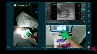 EchoLaser&reg; TPLA&trade; - Live Surgery Days with Dr. Parekattil