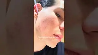 Escribe RUTINA para ayudarte! #melasma #pielperfecta #acne #pielmixta #granos