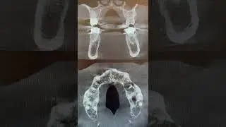 Failed root canal with a LARGE infection