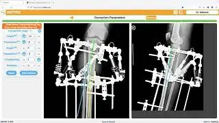 Correcting Leg Deformity: Full Surgical Planning Explained with X-Rays.