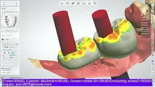Implant+Lower Molar 2 Unit Bridge+3shape+triple tray(bite tray)+E3 scanner+Full Zir. crown+linker