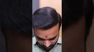 Hair Transplant Result After Months | Real Patient Transformation