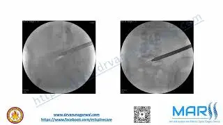 Slip Disc & Anterolisthesis Surgery | Successful Case Under Local Anesthesia | Dr. Varun Agrawal