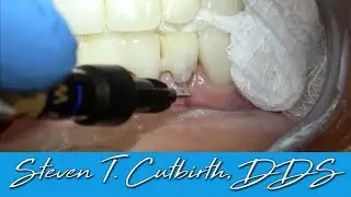 How to Bond a Chipped Veneer - Dental Minute with Dr. Steven T. Cutbirth, DDS