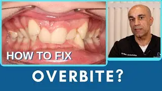 How to Fix Overbite with Braces or Invisalign&reg;?
