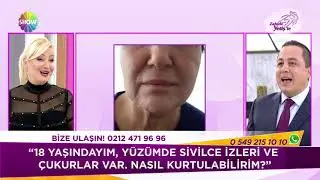 Kök Hücre Tedavisi sivilce izi ve çukurları yok ediyor!