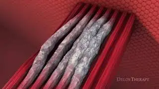 Delos Therapy: Technique (short): Precise Innovative Therapy