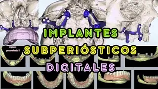 Implantes Subperiósticos digitales