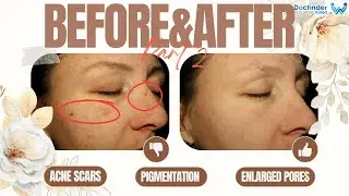 Korean Dermatology - Jane Rog Part 2 pigmentation, wide pores