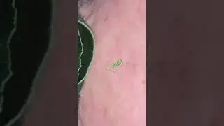 PEEL OFF WHITEEAD & BLACKHEAD USING FAWA GREEN TEA MASKER
