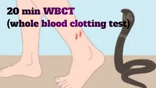 20 WBCT (whole blood clotting test)