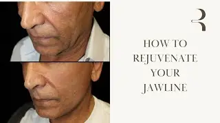 Face & Neck Lift Results for Men | Natural Jawline Rejuvenation &ndash; Ramly Plastic Surgery