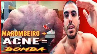 COMO ACABAR COM A ACNE | PARA MAROMBEIROS