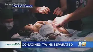 Conjoined twin girls separated at Cook Children's Medical Center
