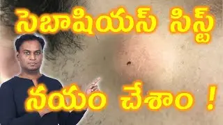 సెబాషియస్ సిస్ట్ చికిత్స | Sebaceous Cyst Permanant Treatment | Skin Cyst Cure Medicine Arogyam Max