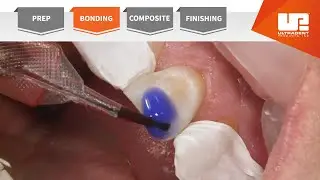 Bonding | Your Complete Restorative Solution